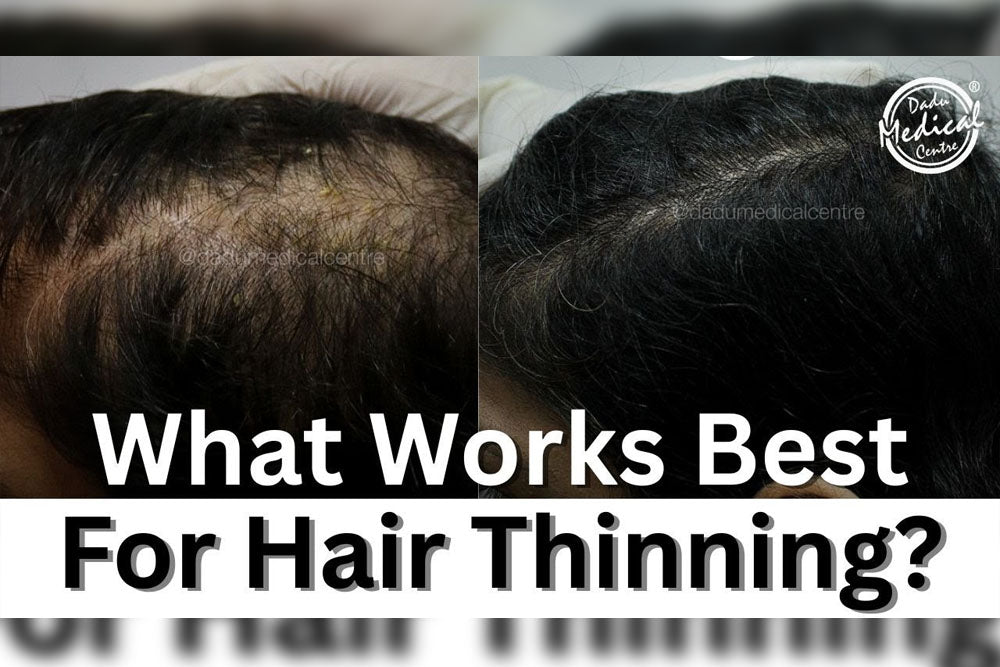 PRP vs GFC vs QR678 vs Exosomes: Comparing Hair Regrowth Treatments in Delhi