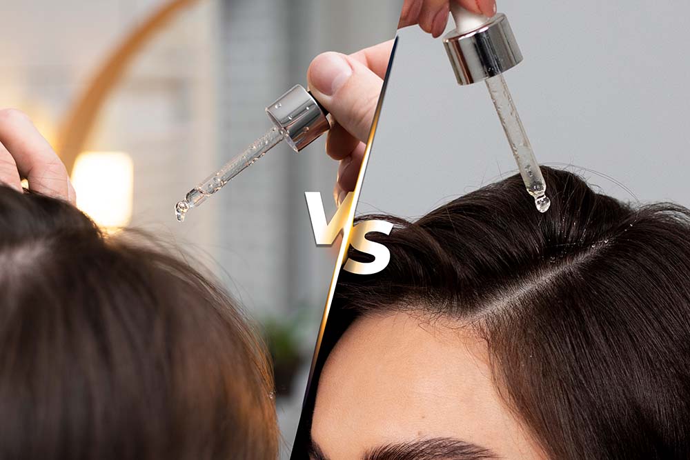 Minoxidil 5% vs 10% – Which One Actually Works Better for Hair Loss?